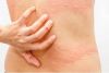 URTICARIA Y ALERGIAS