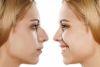 RINOPLASTIA