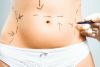ABDOMINOPLASTIA