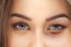 BLEFAROPLASTIA