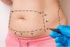 ABDOMINOPLASTIA