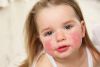 ROSACEA