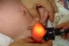 ALTERACIONES DE DESCENSO TESTICULAR