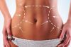 ABDOMINOPLASTIA