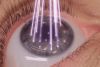 CIRUGÍA REFRACTIVA