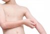 URTICARIA CRÓNICA