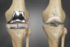 ARTROPLASTIA DE RODILLA