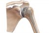 ARTROPLASTIA DE HOMBRO