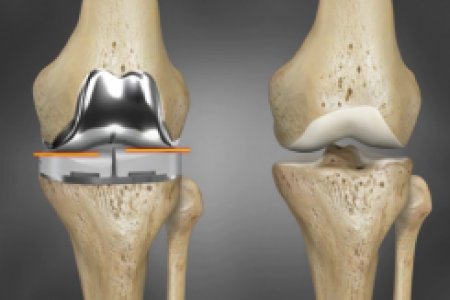 ARTROPLASTIA DE RODILLA