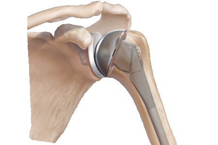 ARTROPLASTIA DE HOMBRO